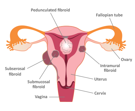 What is the treatment for ovarian fibroids?